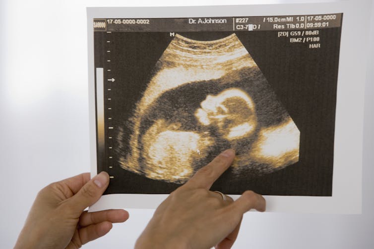 An image of a growing fetus in a sonogram and a finger pointing at it.