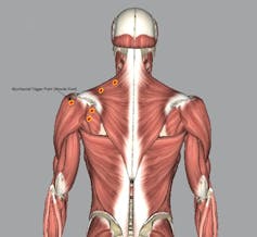 Modelo de la musculatura de una persona adulta con puntos rojos que muestran las posibles ubicaciones de los nudos musculares
