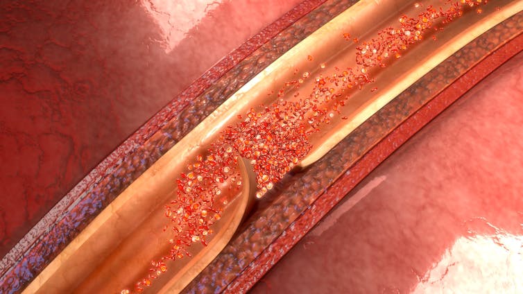 A digital illustration of an aortic dissection, which happens when the lining of the blood vessel develops a tear.
