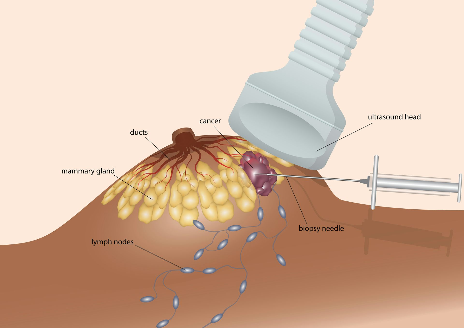 Biopsies Confirm A Breast Cancer Diagnosis After An Abnormal Mammogram ...