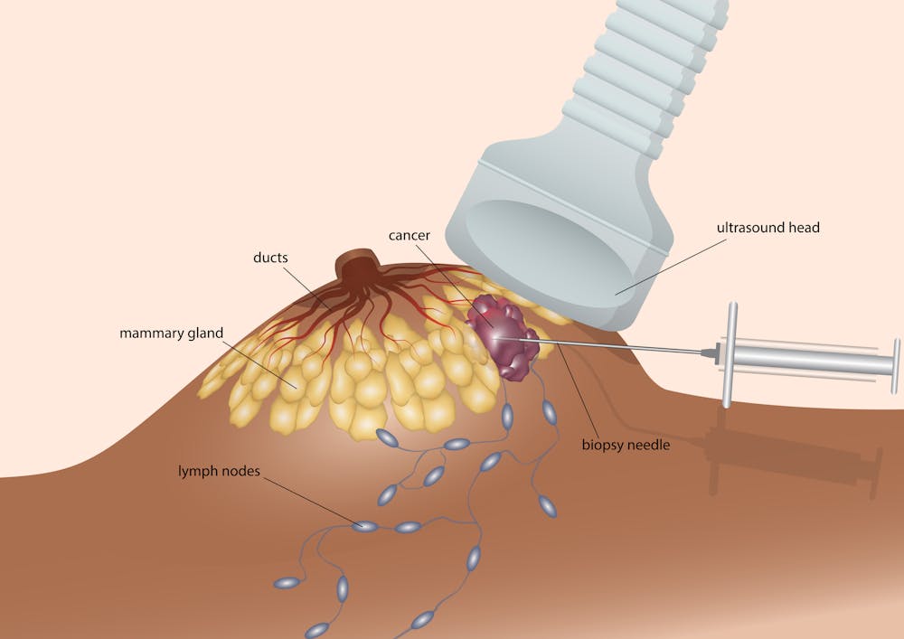 Biopsies Confirm A Breast Cancer Diagnosis After An Abnormal Mammogram biopsies-confirm-a-breast-cancer-diagnosis-after-an-abnormal-mammogram