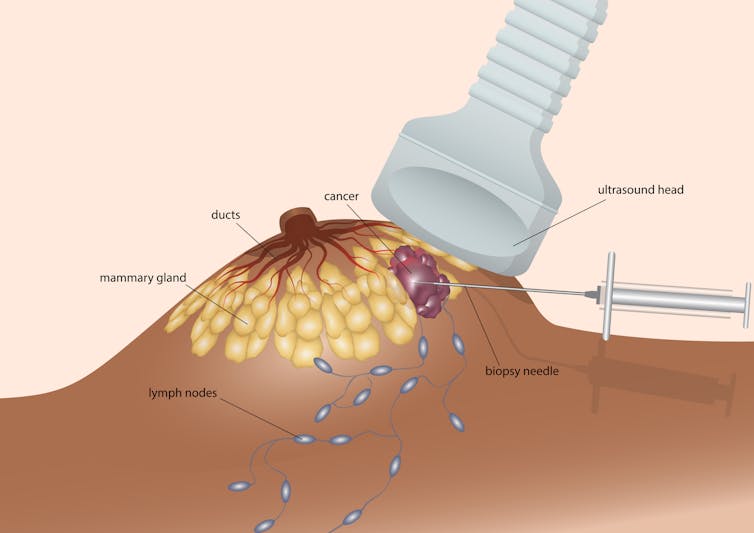 Diagram of ultrasound-guided breast biopsy