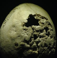 skull with hole and areas where bone looks rotted away