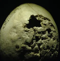 skull with hole and areas where bone looks rotted away
