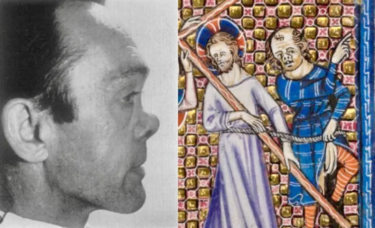 Side view of man with a collapsed nose, paired with medieval painting of Jesus and a persecutor