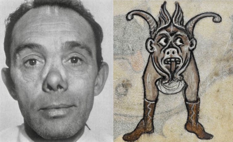 Front view of man with a collapsed nose, paired with drawing of a monster with a snub-nosed face on a pair of legs