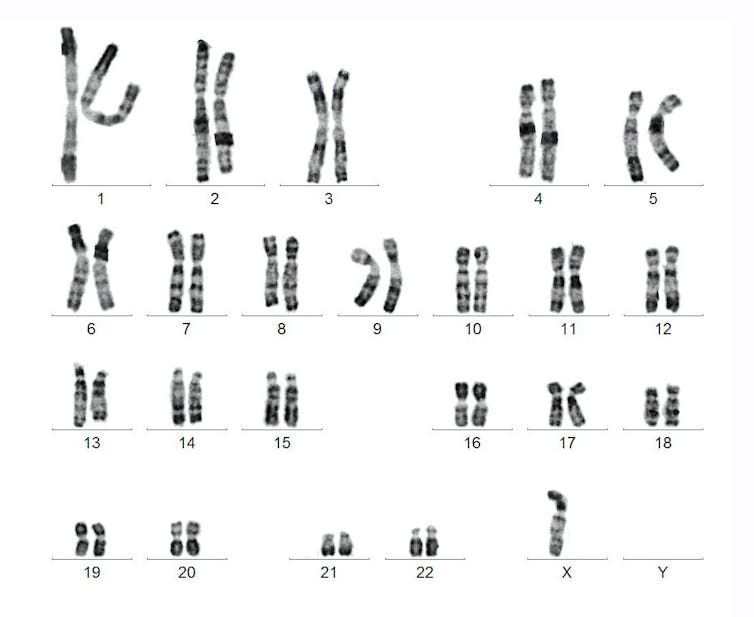 Human karyotype missing a Y chromosome