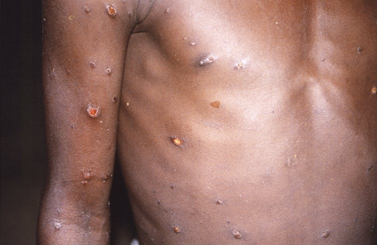 A photo of a man's torso with many small lesions