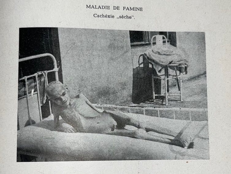 black and white photo of an emaciated boy lying on a bed