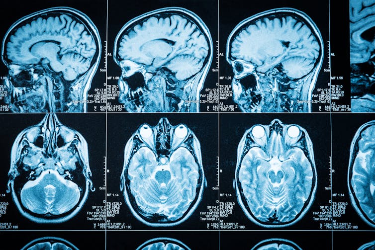 CT brain scans