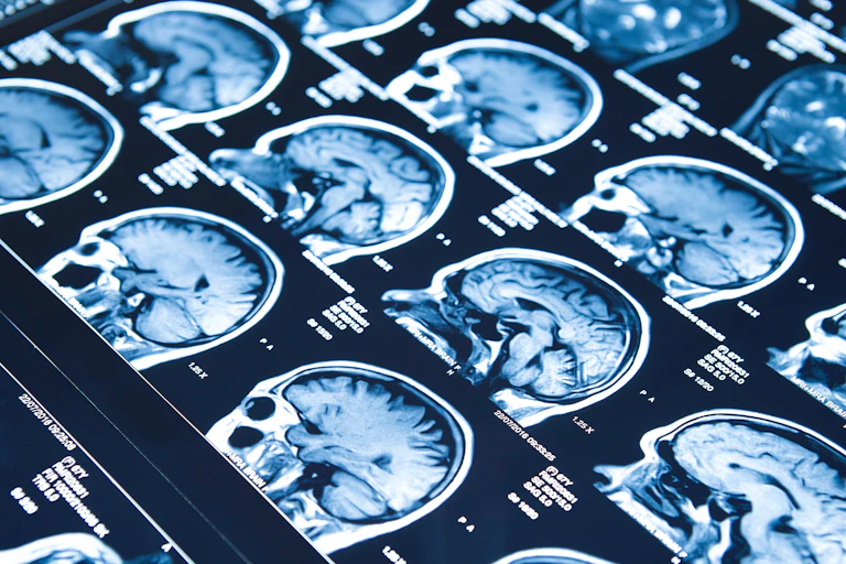Sequential photos of an individual' skull and brain.