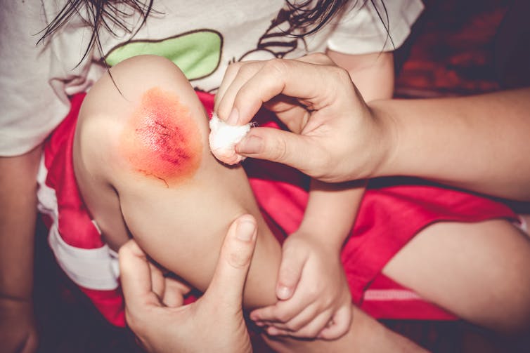 A carer dabs a cotton bud on a child's scraped knee