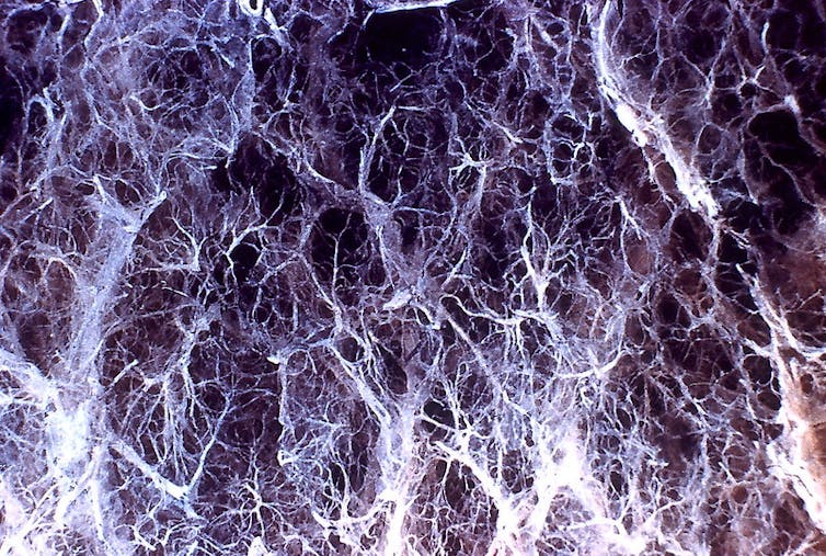 Microscopy image of panlobular emphysema