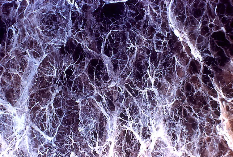Microscopy image of panlobular emphysema