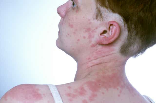 A person suffering a hive breakout from allergic reaction.