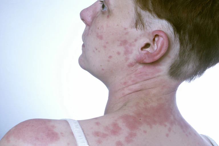 A person suffering a hive breakout from allergic reaction.