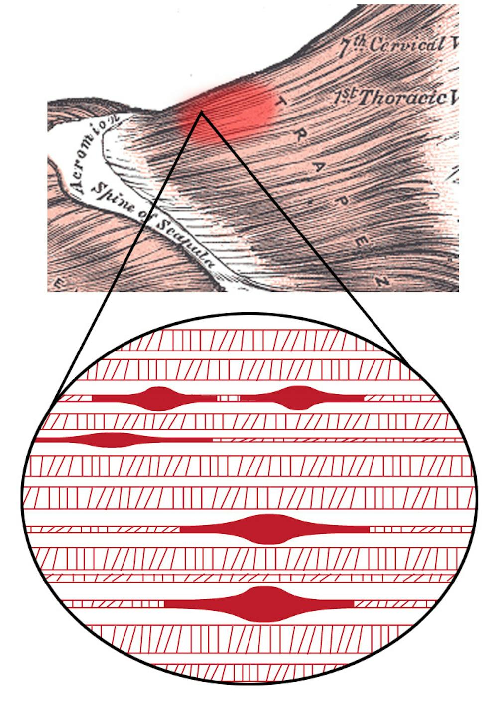 What are muscle knots? An exercise physiologist explains what ...