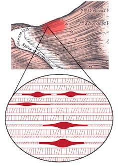 diagram of skeletal muscle with a closeup of bands of fibers with lumpy spots