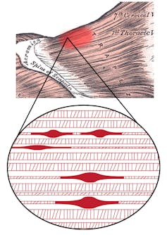 Inflammation is what causes the muscle fibers to feel as if a little pea is stuck inside. (David Parmenter/Wikimedia Commons, CC BY-SA)