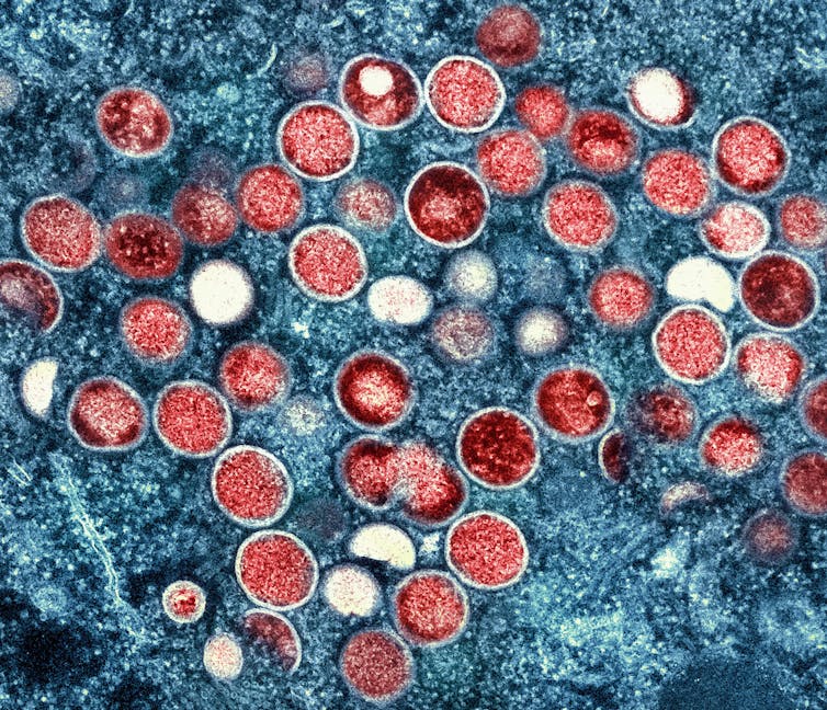 Electron microscope image of monkeypox particles