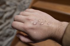 Hand with raised, fluid-filled bumps on the back of the hand