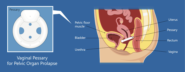 diagram of pessary and prolapse