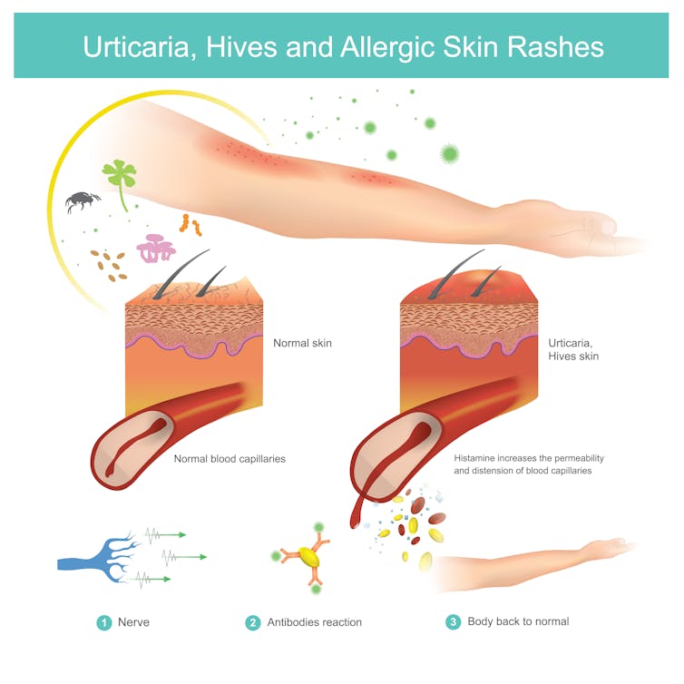 Diagram of urticaria allergic reaction