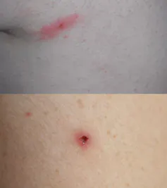 Photos de différentes réactions à la piqûre d’une tique femelle Ixodes ricinus : hypersensibilité à la salive voire nécrose au point de piqûre.