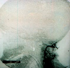 Arteriografía que muestra una zona oscura en el encéfalo.
