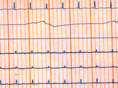 Electroencefalograma plano.