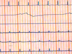 Electroencefalograma plano.