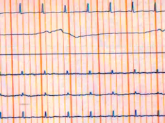 Electroencefalograma plano.