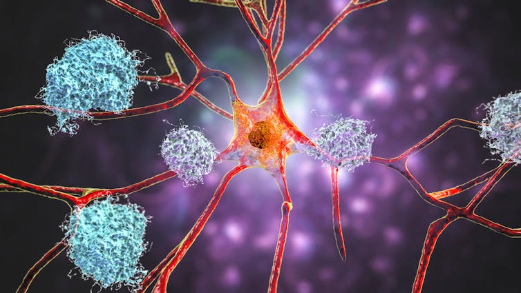 An artist's impression of beta-amyloid plaques clogging up a brain cell.