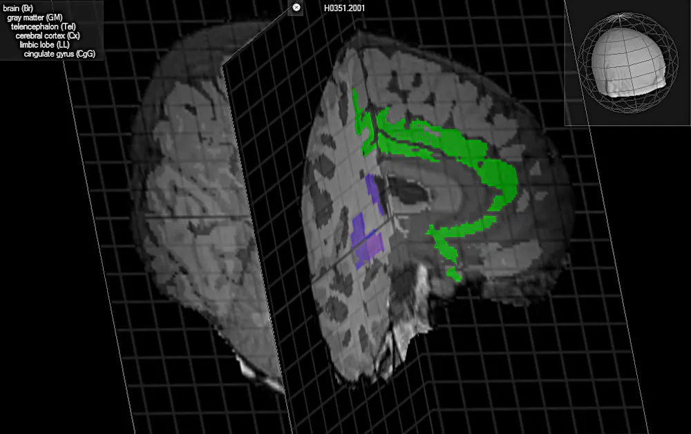 Ccc Model Claustrum Is the key to consciousness in the claustrum?