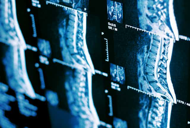 MRI scan of human spine.