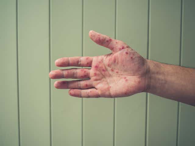 A person's hand, showing hand foot and mouth disease blisters