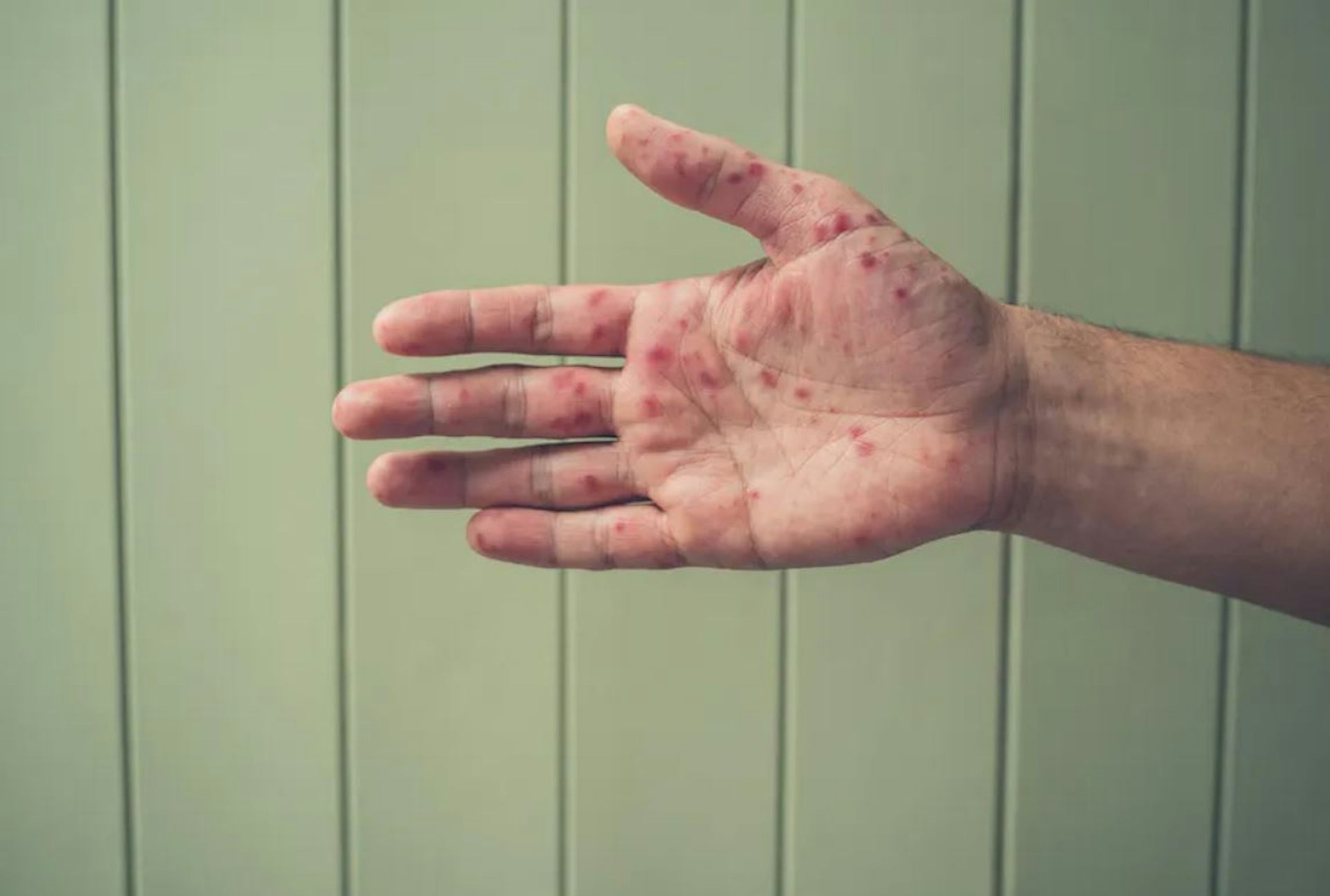 Wabah 'flu tomat' di India &ndash; inilah yang sebenarnya penyakit ini