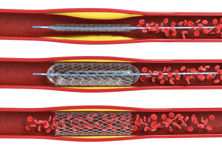 Un grafico raffigurante come uno stent mantiene aperta un'arteria.