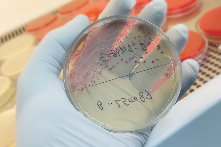 A lab technician wearing surgical gloves holds a petri dish with agar, where a urine sample has grown bacteria.