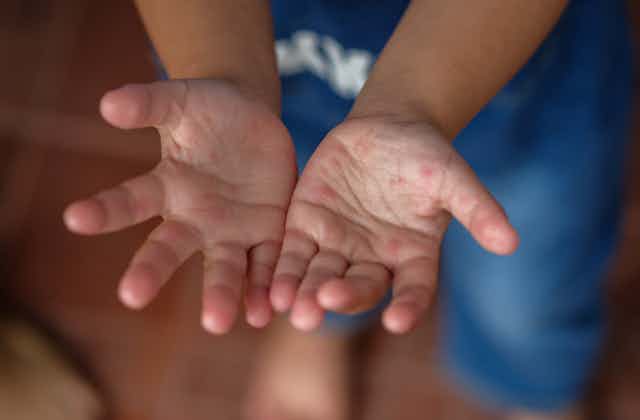 Child with hand, foot and mouth disease