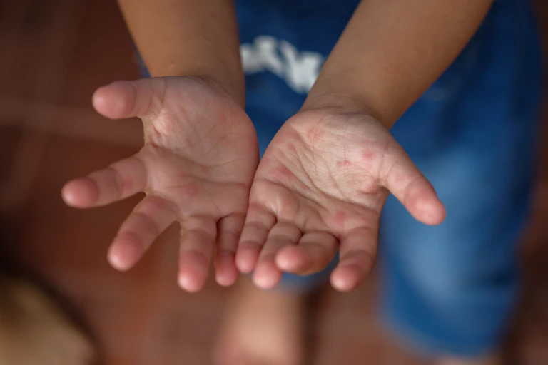 Child with hand, foot and mouth disease