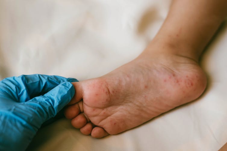 Foot of a child with hand, foot and mouth disease