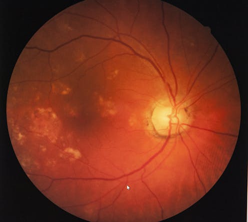 the retina gives away signs of Alzheimer's disease and could help with early detection