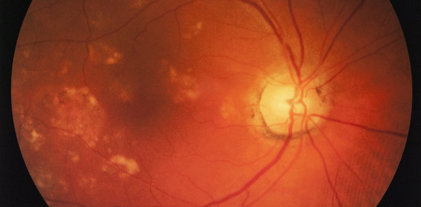 A window to the brain: the retina gives away signs of Alzheimer’s ...