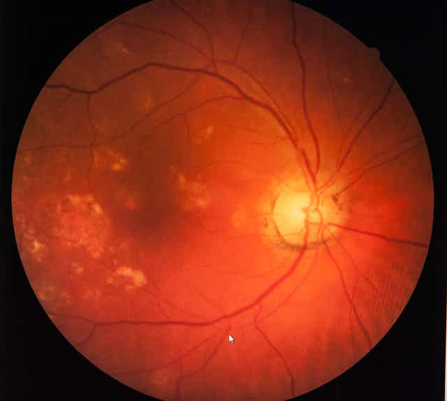Photograph of the retina, showing the retinal vascular system, the macula (the centre of vision, which appears as a dark spot in the middle of the image) and the optic disc (where the retinal ganglion cells leave the eye to form the optic nerve, shown as a yellow disc to the right of the photograph).