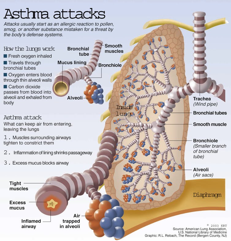 Breathe easy? Good and bad news about asthma