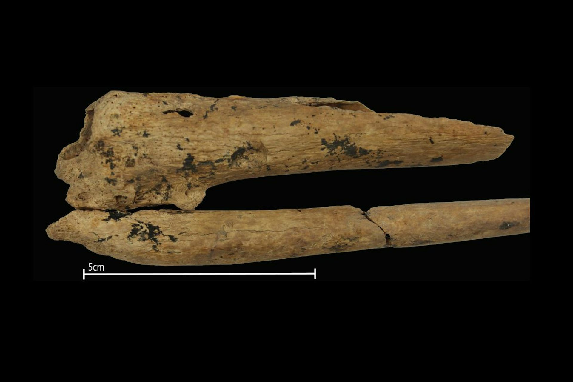 World’s Earliest Evidence Of A Successful Surgical Amputation Found In ...