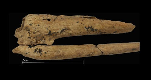 World's earliest evidence of a successful surgical amputation found in 31,000-year-old grave in Borneo