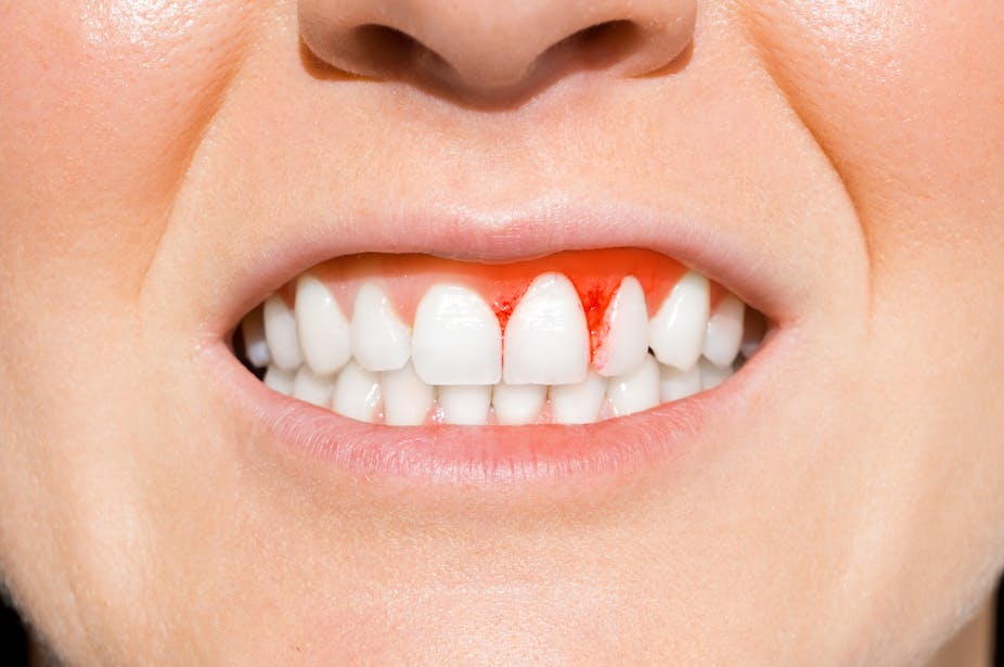 A picture of a person smiling, showing their bleeding gums. 