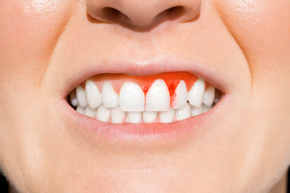 Tooth Red Four health conditions linked to gum disease